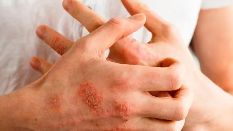 Dermatitis atópica; te quita el sueño, aumenta la ansiedad y