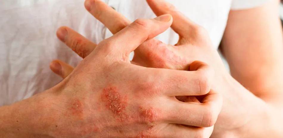 Dermatitis atópica; te quita el sueño, aumenta la ansiedad y el absentismo